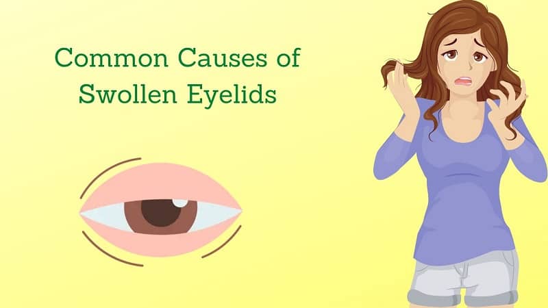 5 Common Causes of Swollen Eyelids – Natural Remedies