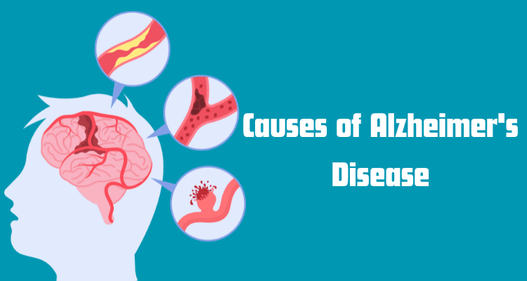 Causes of Alzheimer's Disease