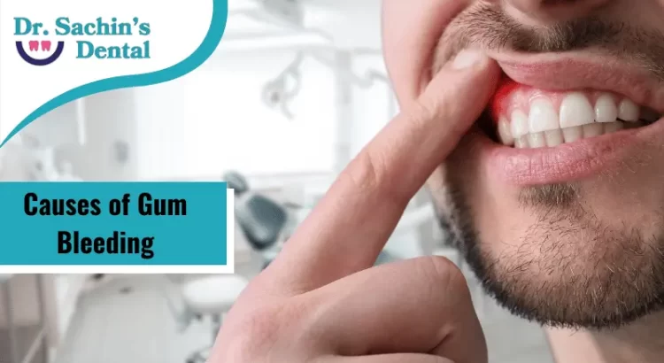 causes of gum bleeding