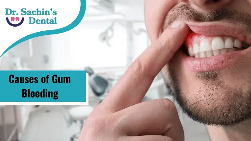 6 Common Causes of Gum Bleeding You Must Be Aware of
