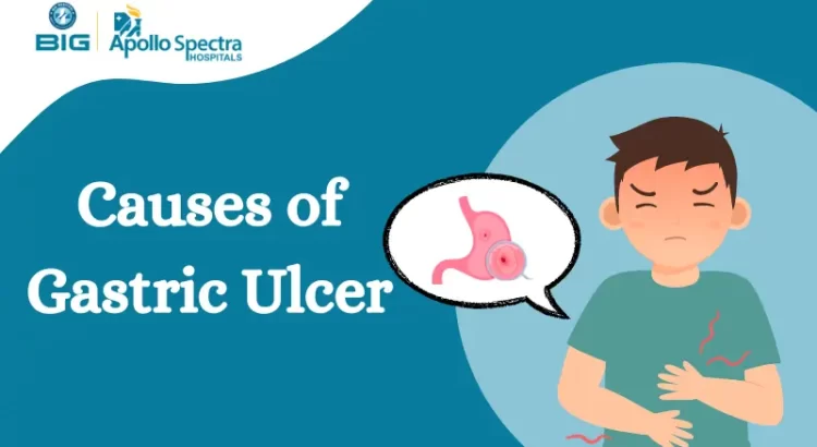 Causes of Gastric Ulcer