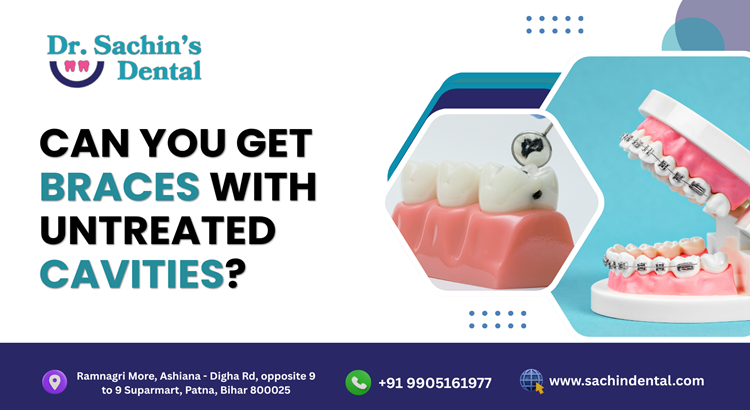 Can You Get Braces If You Have Cavities